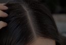 Klinik Trikoloji ve Dermatolojik Nutrisyon: Saç Derisi Sebum Anomalilerinde Epidermal Bariyer Restorasyonu ve Lokal Fitoterapötik Yaklaşımlar!
